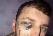 Everton fan Jay Burns reveals horrific scar he received from Millwall thug