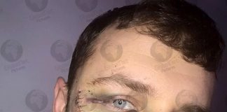 Everton fan Jay Burns reveals horrific scar he received from Millwall thug
