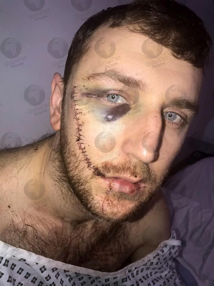 JAY BURNS-EVERTON FAN WITH FACE SLASHED-MILLWALL V EVERTON VIOLENCE-FA CUP